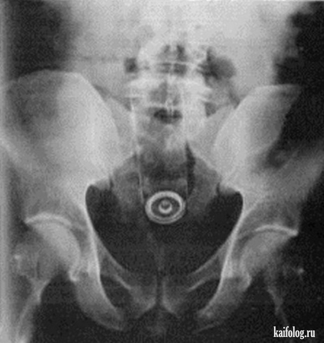 Что покажет рентген турецкого седла?